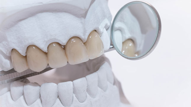 Zahnarztpraxis-Dr.-Katrin-Muehlenbeck-Implantatversorgung